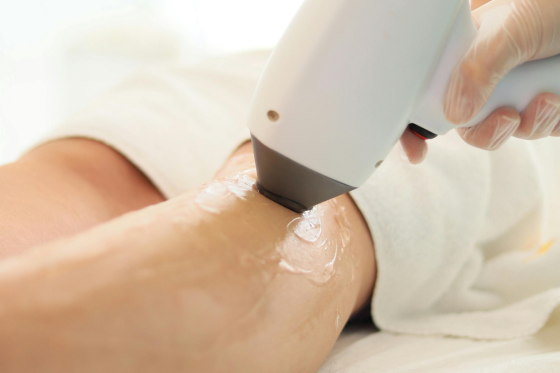 Laser hair removal and hand rejuvenation at SkynBar Atlanta
